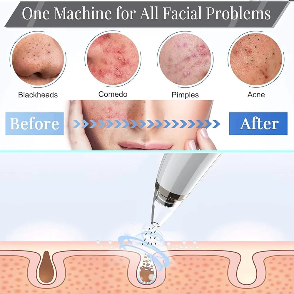 5 in 1 Electric Blackhead Acne Oil Remover